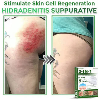 🍀70%off Hudros® 2-in-1 Microneedle & Hydrocolloid Patch | Raised Moles,Acne,  Flat Warts & Skin Tags Remover | Improves Wrinkles, Scars & Blemishes | Invisible Star Pimple Patches for Face & Body | 144 Count