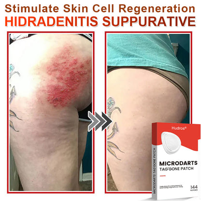 70%📌Hudros® 2-in-1 Microneedle & Hydrocolloid Patch | Raised Moles,Acne,  Flat Warts & Skin Tags Remover | Improves Wrinkles, Scars & Blemishes | Invisible Star Pimple Patches for Face & Body | 144 Count