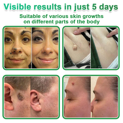 🚚70%off Hudros® 2-in-1 Microneedle & Hydrocolloid Patch | Raised Moles,Acne,  Flat Warts & Skin Tags Remover | Improves Wrinkles, Scars & Blemishes | Invisible Star Pimple Patches for Face & Body | 144 Count