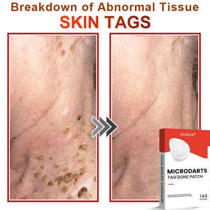 70%📌Hudros® 2-in-1 Microneedle & Hydrocolloid Patch | Raised Moles,Acne,  Flat Warts & Skin Tags Remover | Improves Wrinkles, Scars & Blemishes | Invisible Star Pimple Patches for Face & Body | 144 Count