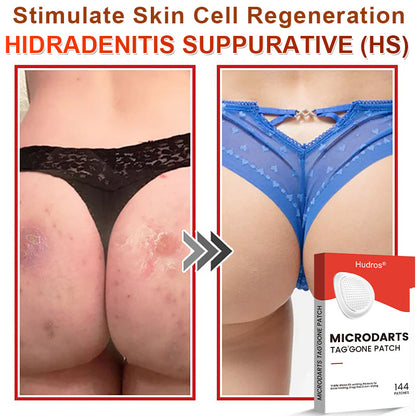 70%📌Hudros® 2-in-1 Microneedle & Hydrocolloid Patch | Raised Moles,Acne,  Flat Warts & Skin Tags Remover | Improves Wrinkles, Scars & Blemishes | Invisible Star Pimple Patches for Face & Body | 144 Count