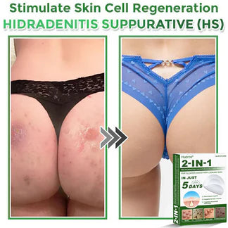 🍀70%off Hudros® 2-in-1 Microneedle & Hydrocolloid Patch | Raised Moles,Acne,  Flat Warts & Skin Tags Remover | Improves Wrinkles, Scars & Blemishes | Invisible Star Pimple Patches for Face & Body | 144 Count