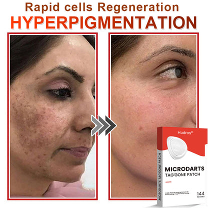 70%📌Hudros® 2-in-1 Microneedle & Hydrocolloid Patch | Raised Moles,Acne,  Flat Warts & Skin Tags Remover | Improves Wrinkles, Scars & Blemishes | Invisible Star Pimple Patches for Face & Body | 144 Count