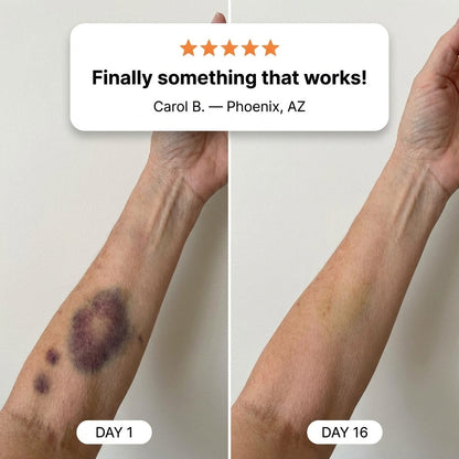 💥100K+ SOLD💕- CureVivo®  Bruise Repair & Skin Strengthening Cream